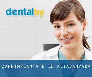 Zahnimplantate in Altacanyada