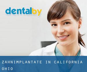 Zahnimplantate in California (Ohio)